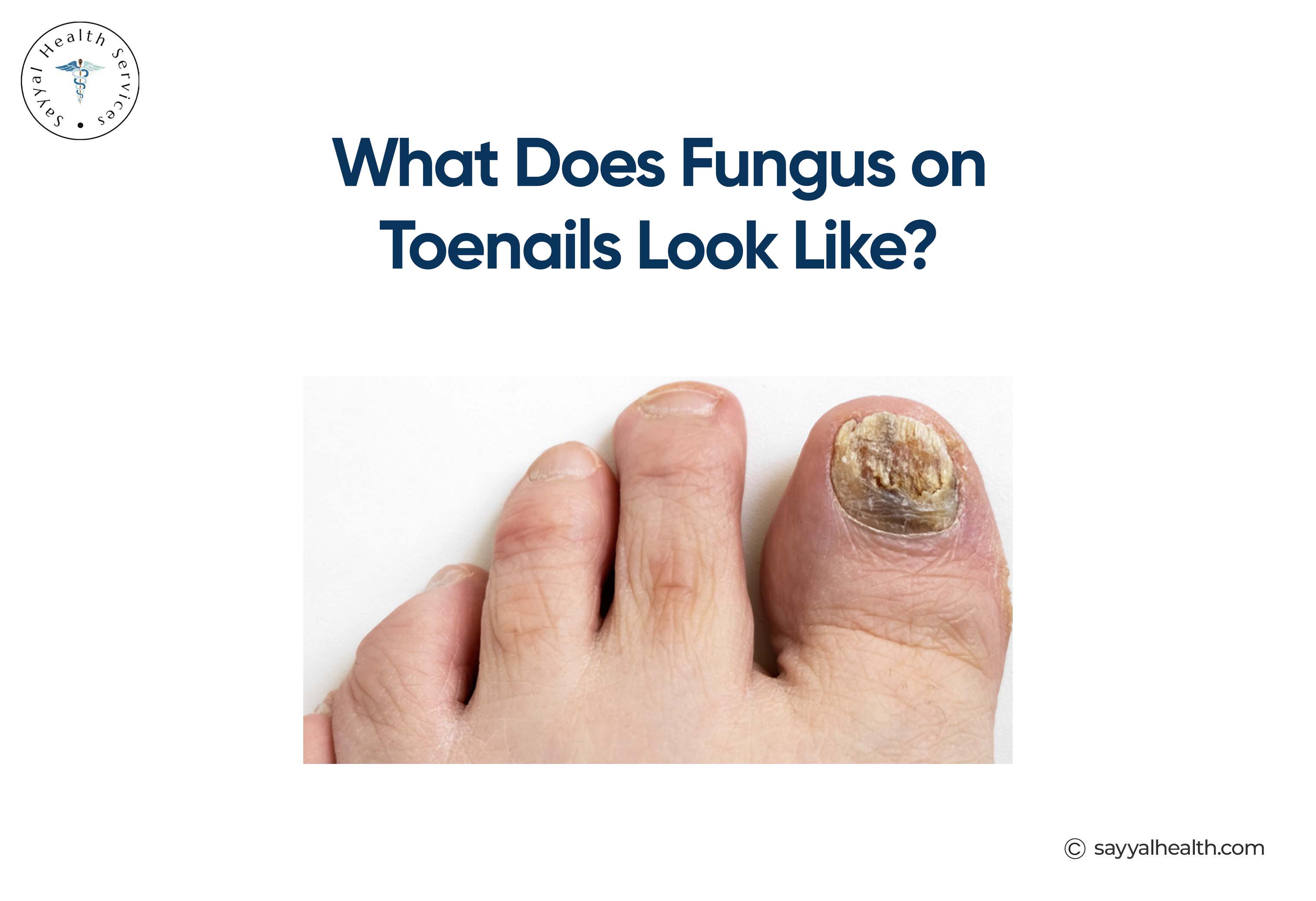 What Does Fungus on Toenails Look Like?